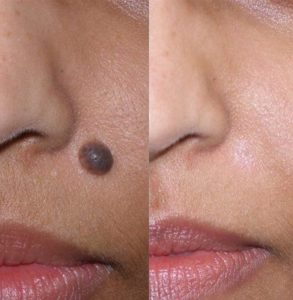 Mole removal - before and after
