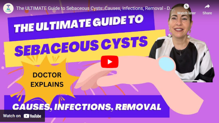 Everything About Sebaceous Cysts